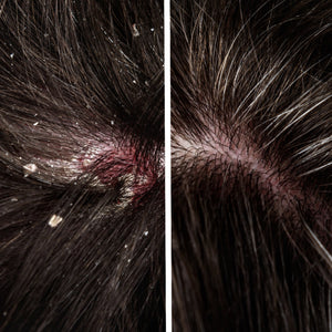 SHAMPOO CONTROL PSORIASIS TRATAMIENTO PARA 3 MESES