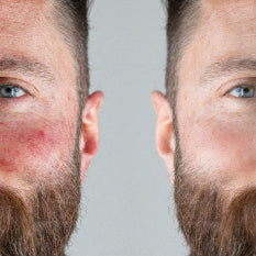CREMA REGENERANTE CONTROL PSORIASIS TRATAMIENTO PARA 3 MESES