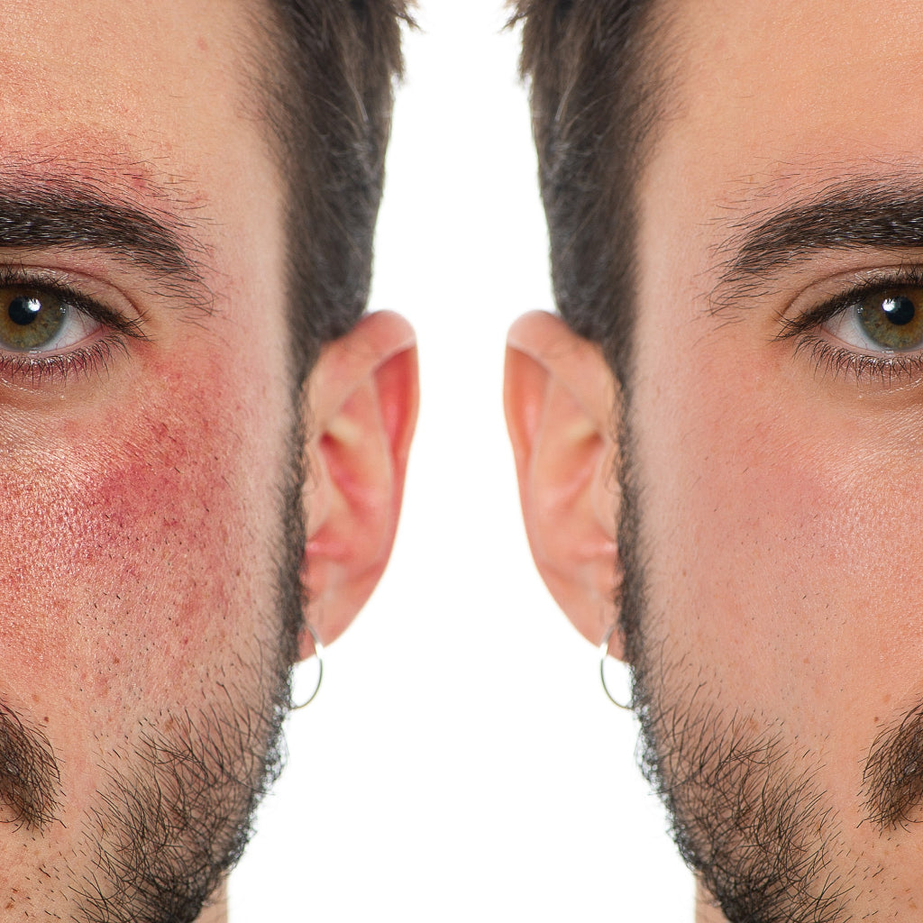 GEL CALMANTE CONTROL PSORIASIS TRATAMIENTO PARA 3 MESES