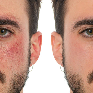 GEL CALMANTE CONTROL PSORIASIS TRATAMIENTO PARA 3 MESES