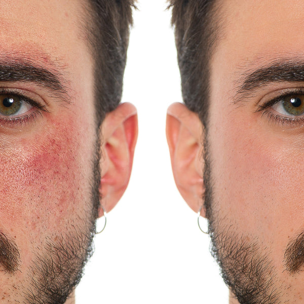 GEL CALMANTE CONTROL PSORIASIS TRATAMIENTO PARA 3 MESES